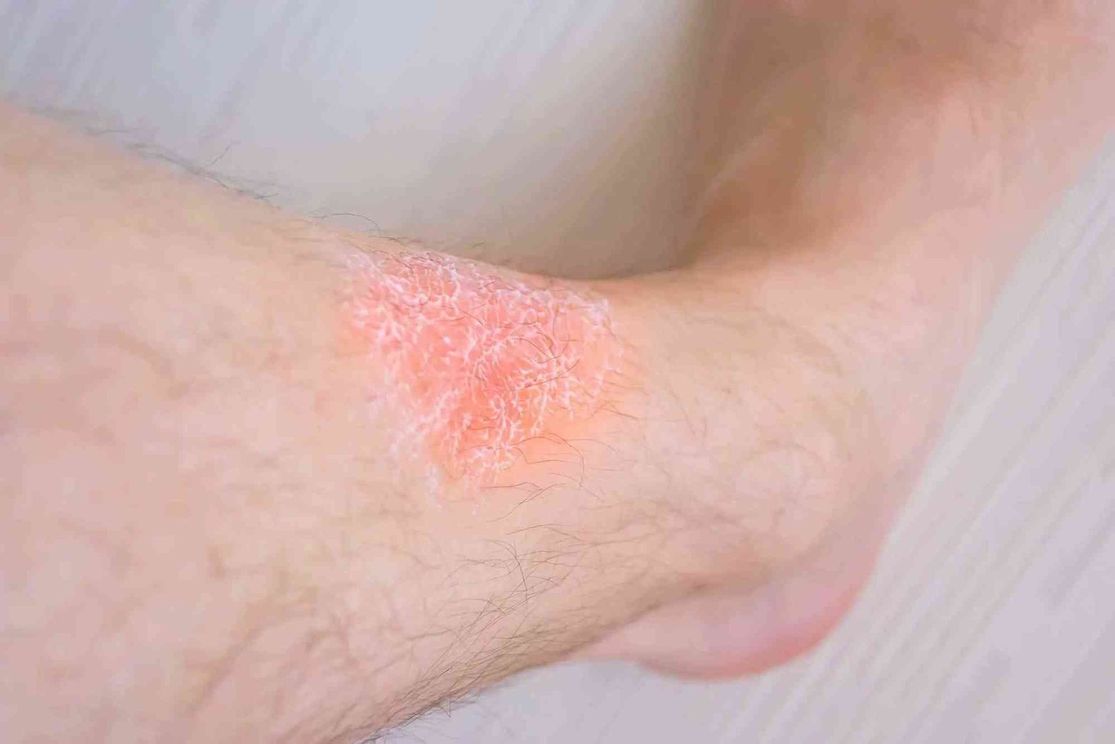 How to Eliminate Stasis Dermatitis Essential Guide