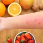 Come Eliminare Dermatite Sda Stasi: Explained