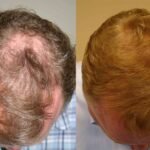 Hair Transplant Turkey